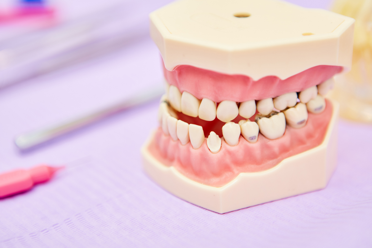 Malocclusione dentale: cause e rimedi